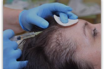 grados de la calvicie