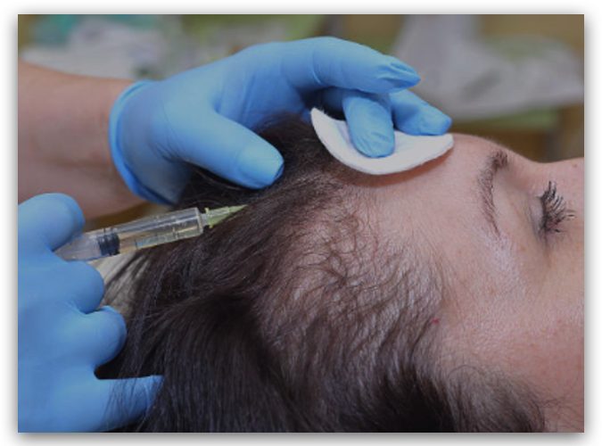 grados de la calvicie